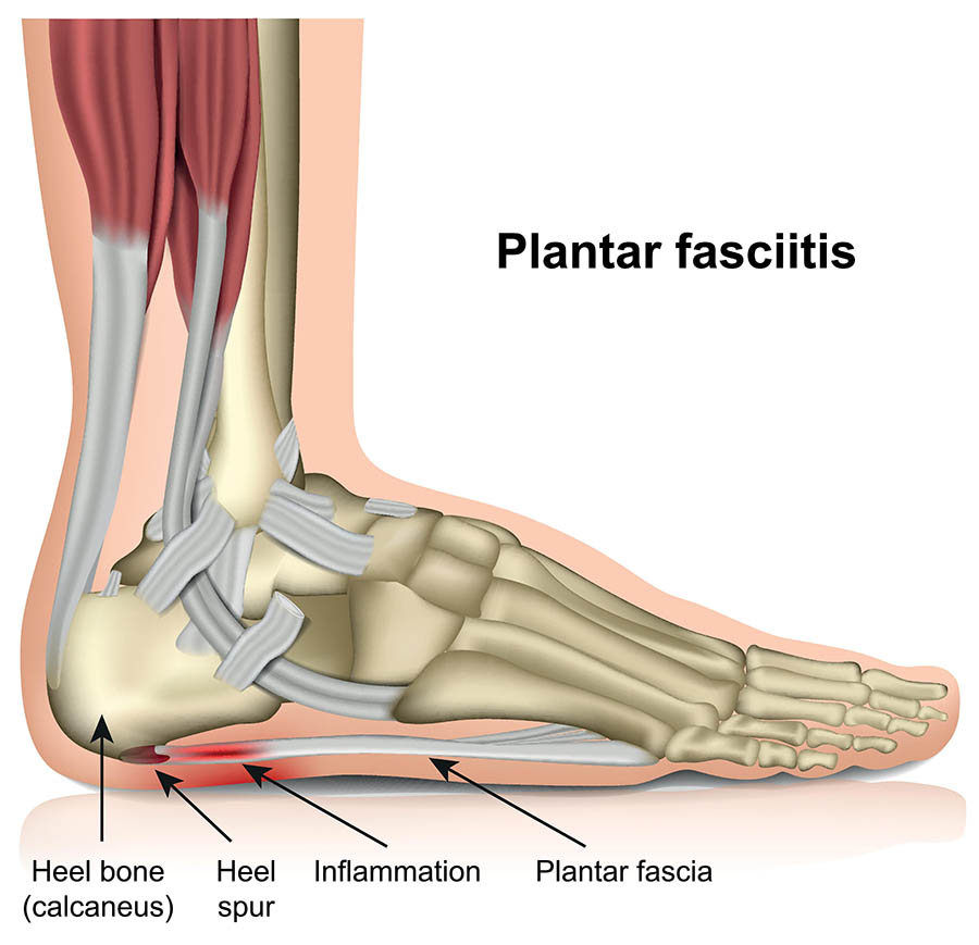 Plantar Fasciitis Treatment
